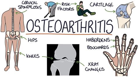 Symptoms Of Osteoarthritis And Treatment - HealthPally.com