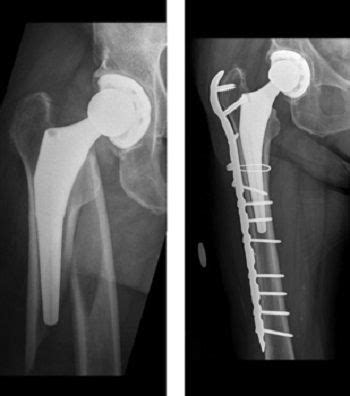 Get Hip Bone Fracture Treatment UK