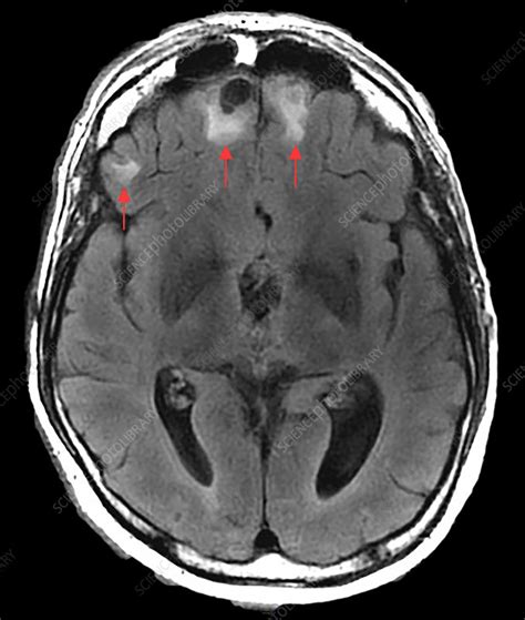 Chronic Post-Traumatic Brain Injury, MRI - Stock Image - C030/6070 ...