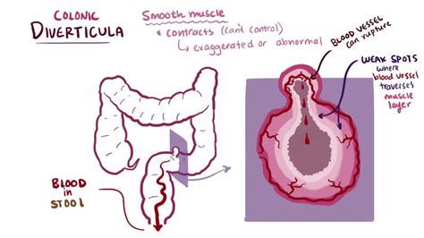 Diverticulitis - Digestive Disorders - MSD Manual Consumer Version