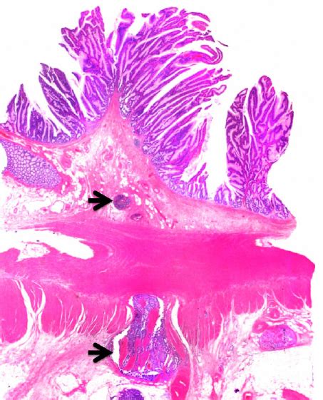 Residual villous adenoma in resection specimen showing transmural ...