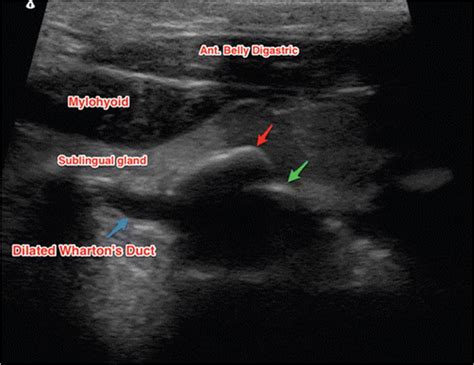 Ultrasound of the right submandibular/floor of the mouth region ...