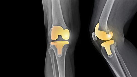 Knee Replacement Surgery: Risks and What to Expect