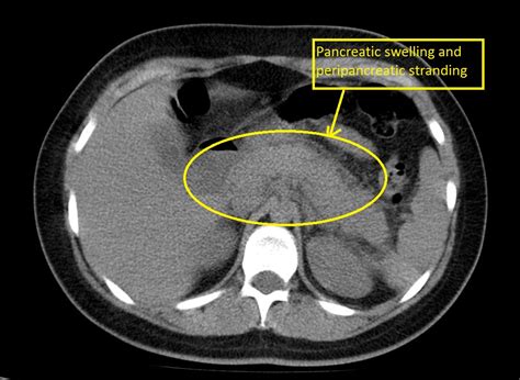 Acute pancreatitis CT - wikidoc