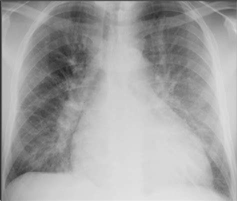 MBBS Medicine (Humanity First): Chest radiograph of different conditions