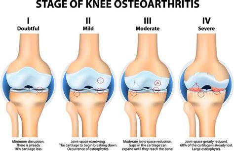 Knee Osteoarthritis - Sun Orthopaedic