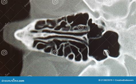 CT Scan of the Ethmoid Sinus Air Cells Stock Photo - Image of maze ...