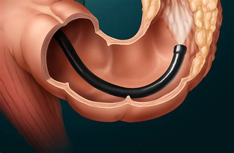 Colonoscopy and Sigmoidoscopy Prep Day Laxative And Procedure My Story ...