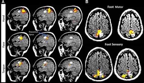 Functional MRI in Neuro-Oncology: State of the Art and Future ...