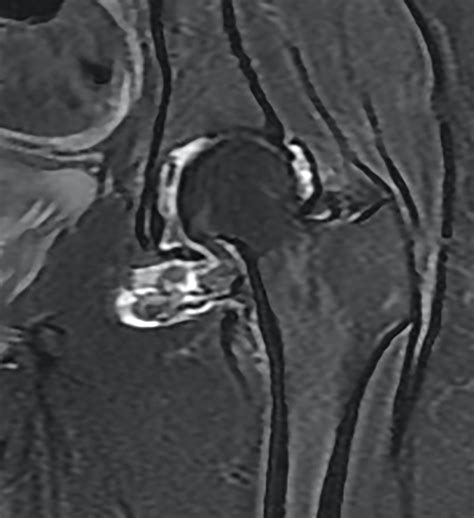 Giant Cell Tumor Of Tendon Sheath Mri