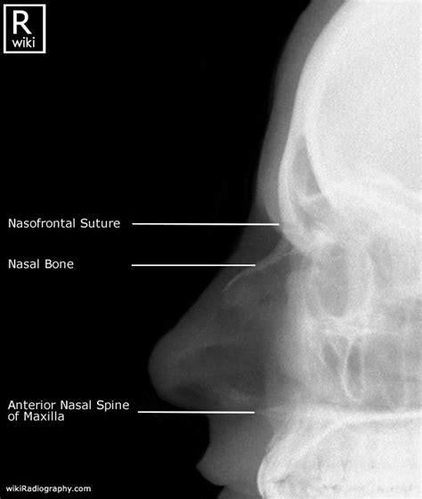 Nasal Bones - Lateral - Radiographic Anatomy | Medical radiography ...