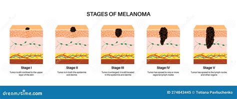 The Stage III Melanoma Tumors Stock Photo | CartoonDealer.com #281924052