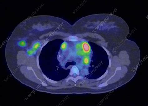 Lymphoma: Pet Scan Lymphoma