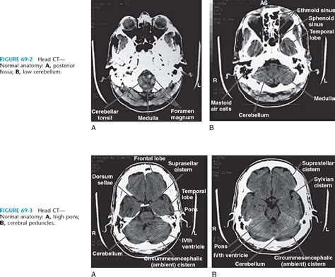 Ct Scan Brain Anatomy - Anatomy Reading Source