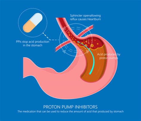 The Serious Health Risks Of PPIs — from Hypochlorhydria To COVID-19 ...