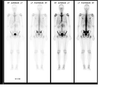 Biomedical Engineering: GAMMA CAMERA