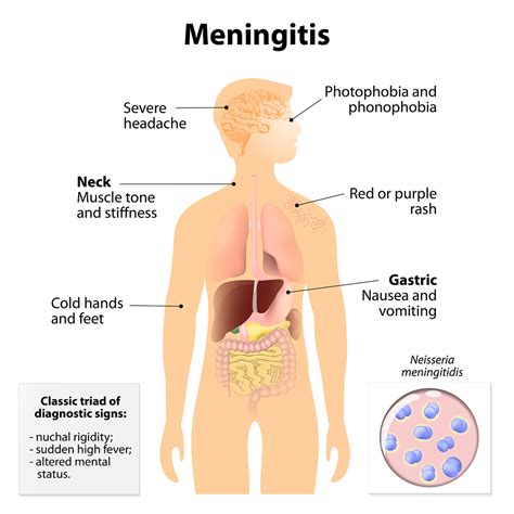 Viral Meningitis Symptoms