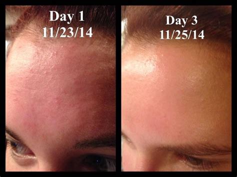 This is my story and it's pretty simple. I had awful bumps all over my ...