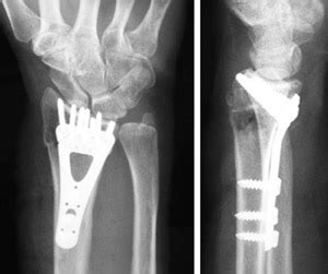 Fractures of the Hand and Wrist - Hand Surgeons in Western Mass ...