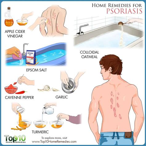 Psoriasis: Home Remedies for Relief and When to See a Doctor | Top 10 ...