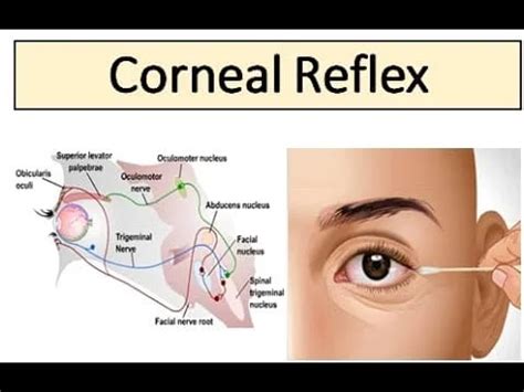 corneal reflex Archives - Mobility Physiotherapy Clinic