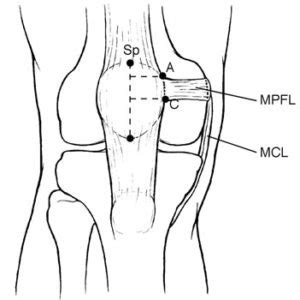 MPFL Injury: Medial Patellofemoral Ligament (MPFL) Tear ...