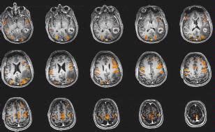 Radiology Exam: Functional MRI | Johns Hopkins Radiology