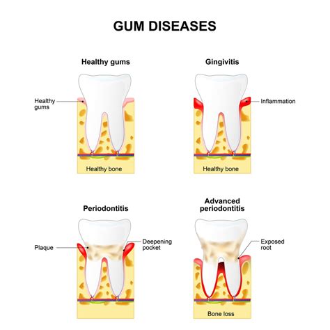 Gum Disease Diagram