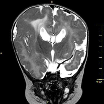 Lissencephaly Brain