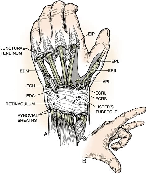 Extensor Tendon Injury - Clinical Tree