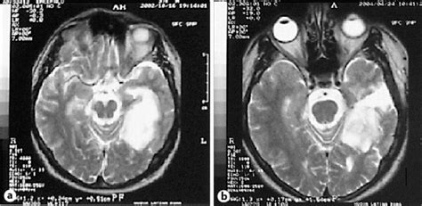 a MRI scan, T2 imaging and axial view: a deep left insular lesion in ...