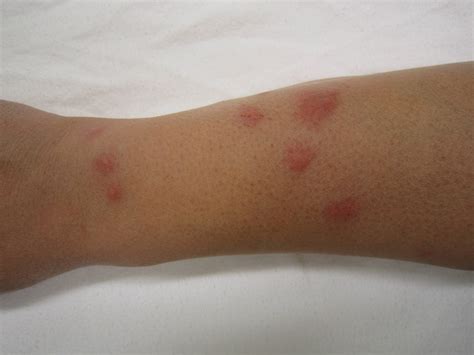 Identifying Insect Bites & Stings