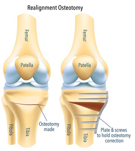 Realignment Osteotomy Surgery | Osteotomy Knee Surgery