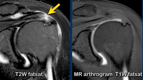 Rotator Cuff Tear X Ray