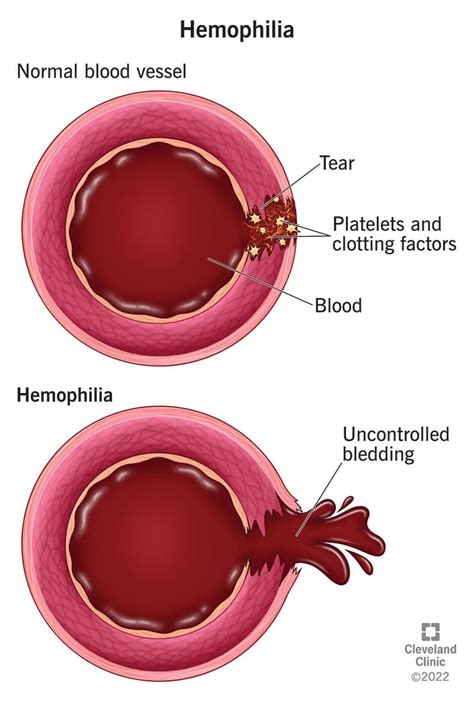 What Is Hemophilia?