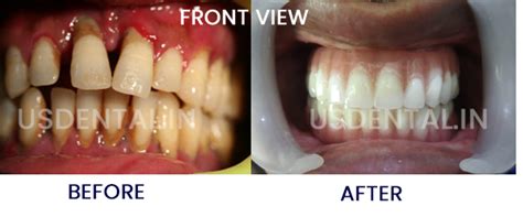 What is the best treatment option for a loose tooth? | US Dental