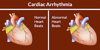 Heart-Related Disease