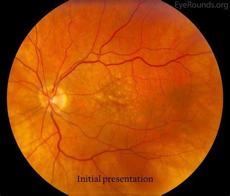 Age-related macular degeneration