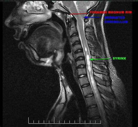 Foramen Magnum Mri