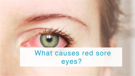 What causes red sore eyes? - YouTube