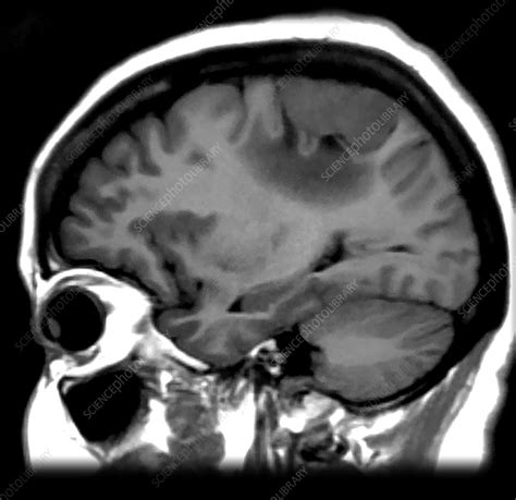 Meningioma, MRI - Stock Image - C058/4474 - Science Photo Library