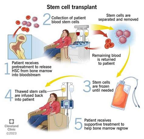 Physiotherapy in Stem Cell Transplantation - Physiopedia