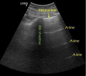 Lung ultrasound: A and B-lines – NephroPOCUS