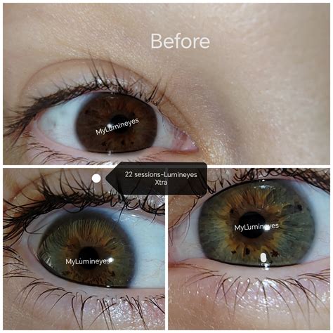 Reviews Of The Best Surgery For Changing Eye Color