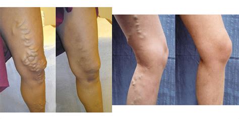 Varicose Veins Treatment: A Q&A with UCSF Interventional Radiologists ...