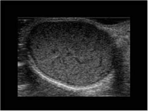 Atheroma Cyst