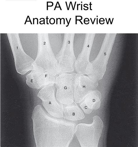 Carpal Bones X-Ray Diagram | Quizlet