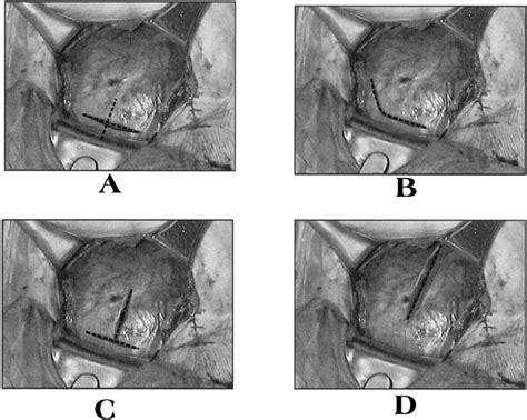 Cesarean Birth: Surgical Techniques | GLOWM