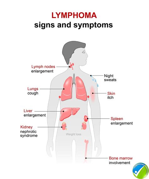 Cancer In Groin Lymph Nodes