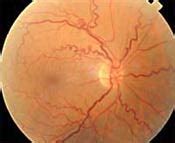 Ocular ischemic syndrome: an indicator of significant systemic disease